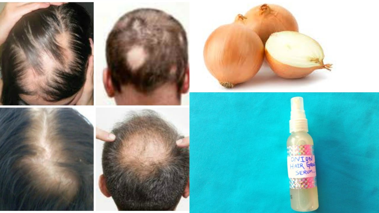  cure your baldness